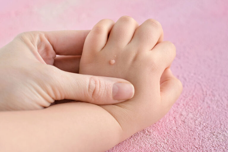 Ways to Get Rid of Warts
